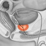 Аденома простаты - лечение, симптомы, операции