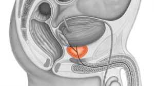 Аденома простаты - лечение, симптомы, операции